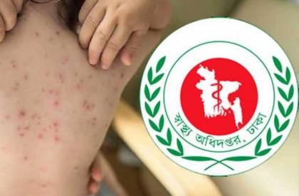 ২৪ ঘণ্টায় হামের উপসর্গ নিয়ে ৪ শিশুর মৃত্যু