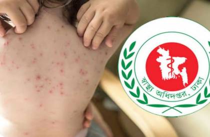 হাম উপসর্গে পাঁচ বিভাগে ৭ জনের মৃত্যু
